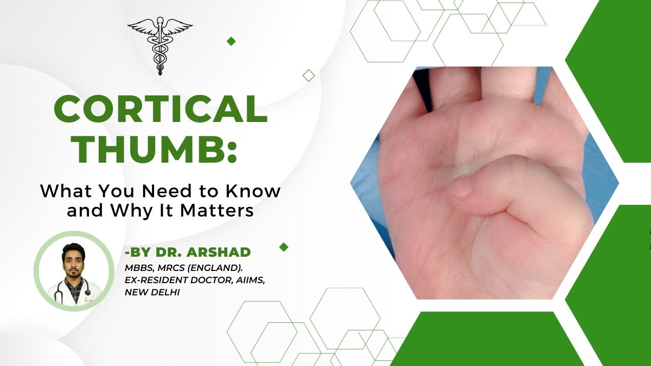 Cortical Thumb What You Need to Know and Why It Matters